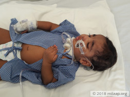 This Baby's Brain Presses On His Spinal Cord And He Chokes On His Food