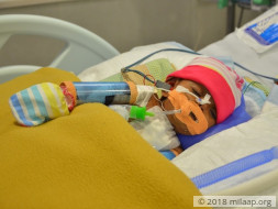 Help This Baby Girl Who Was Born Premature With 3 Holes In Her Heart