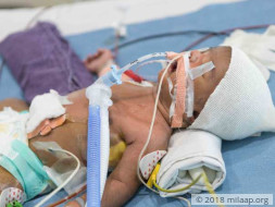 "My 2-week-old Baby Is Fighting To Stay Alive After A Heart Surgery"
