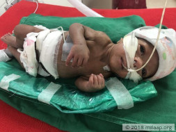 Help Vishakha and Vinayak save their premature baby boy