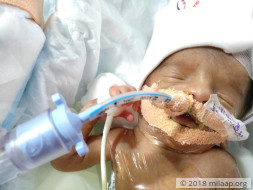 Help Stuti and Anurag save their premature baby boy