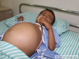 Baby's Stomach Has Swollen To The Size Of A Football Because Of Cancer