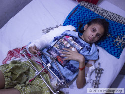 After Falling From The Third Floor,15-year-old has Multiple Fractures