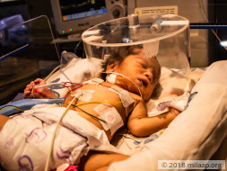 This 2-day-old's Intestines Are Pushing Into His Heart and Lungs