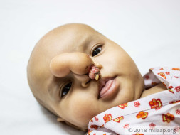 5-month-old Shanti has a rare condition which doesn't let her breathe