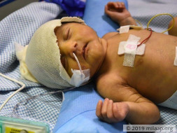 16 days old Baby of Saha needs an open heart surgery to survive.