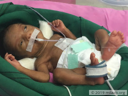 Priyanka Premature Babies Are Struggling To Live In The ICU