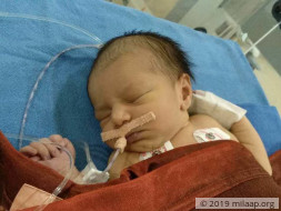 4 Days Old, This Baby Girl Risks Losing Her Life To A Heart Disease