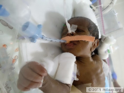 Help Revathi save her baby boy born with a blocked intestine