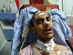 No One Knew That 22-Year-Old's Chronic Headaches Were From Brain Tumor