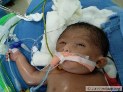 24 Hours To Help This Newborn Get A Lifesaving Open Heart Surgery