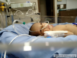 4-day-old Baby Will Suffocate To Death Unless He Has A Surgery