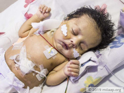 This Baby Boy Born Without Food Pipe Will Die Without Treatment