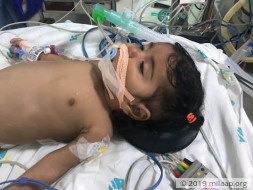 5-month-old Anjali has only 49% Oxygen Level, Needs Heart Surgery