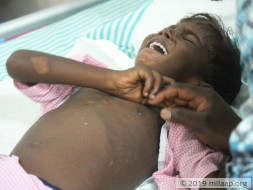 5-year old Hemanth's Stomach Bloat Could Kill Him Without Surgery