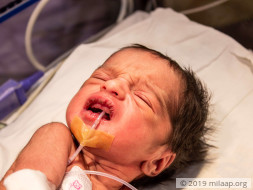 3-Day-Old Baby Born Without A Food Pipe Is Starving And Needs Surgery