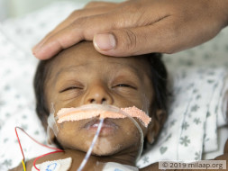 1-Month-Old Intestines Are Damaged Due To Milk Intolerance