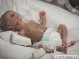 16-Day-Old Premature Baby Needs To Stay In The NICU To Survive