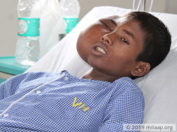 15-Year-Old With Rare Facial Tumor Will Die Without Treatment