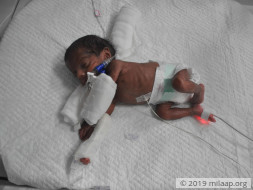 Support Twins of Madhumitha's struggle for life