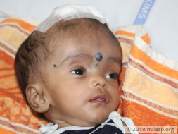 Help 5-month-old Navena suffering from severe brain infection