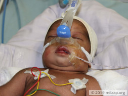 10-Day-Old Baby With A Damaged Brain And Failing Heart Needs Help