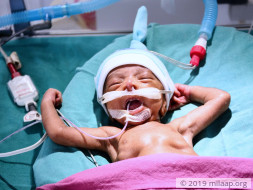 Within Seconds Of His Birth, This Baby Was Fighting For His Life