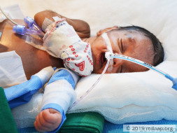 Premature Baby Girl With Underdeveloped Vital Organs Needs Urgent Help