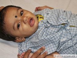 Baby Satvika needs your help to undergo treatment