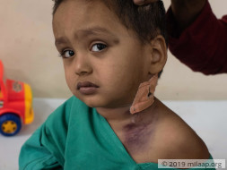 2-Year-Old's Parents Can't Afford The Only Cure For His Rare Disease