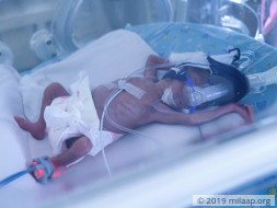 Only 600 Grams At Birth, These Twins Need Help To Survive