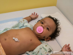 This Baby Who Is Fed Through A Hole In His Stomach Needs Surgery