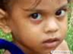 Baby Botta Hema Latha Acute myeloid leukaemia M3