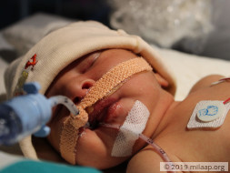Baby of Rayeesa needs your help to survive