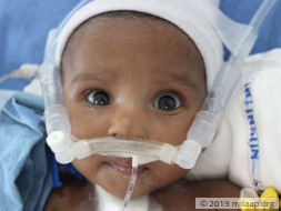 Baby of Srinivas Reneeds your help to survive