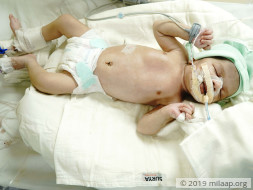 Baby of Manisha needs your help to survive