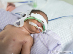 Baby of Arshiya needs your help to survive