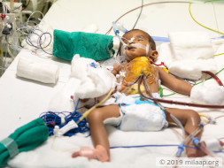 Help Baby of Mallesh Fight Congenital Heart Disease