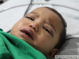 Help Gauri Fight Acute Myeloid Leukemia