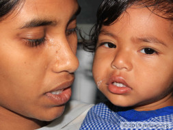 Rishvitha needs your help to undergo her treatment