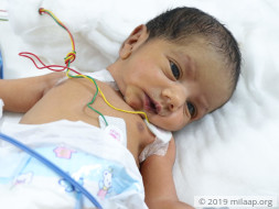 Help Baby of Naziya Undergo ASO + VSD Surgery Closure