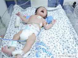 Help Baby of Sirisha Undergo Arterial Switch Operation
