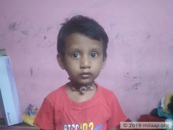 Help Yogesh Recover From Post Intubation Tracheal Stenosis