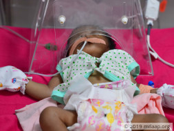 Help Baby Of Gangeswari Undergo Open Heart Surgery