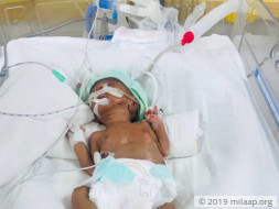 baby of manju devi neonatal sepsis