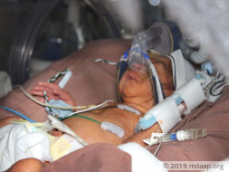 Help My Premature Babies Survive