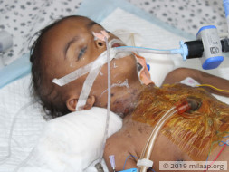 Help Naresh Recover From Congenital Heart Disease