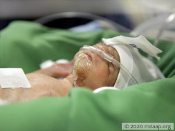 Only 6 Days Old, This Baby Is Not Strong Enough To Breathe On His Own