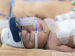 This 6-Day-Old Was Born With Her Intestines On The Outside
