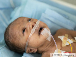 Premature Baby Born With A Hole In The Heart Needs Treatment